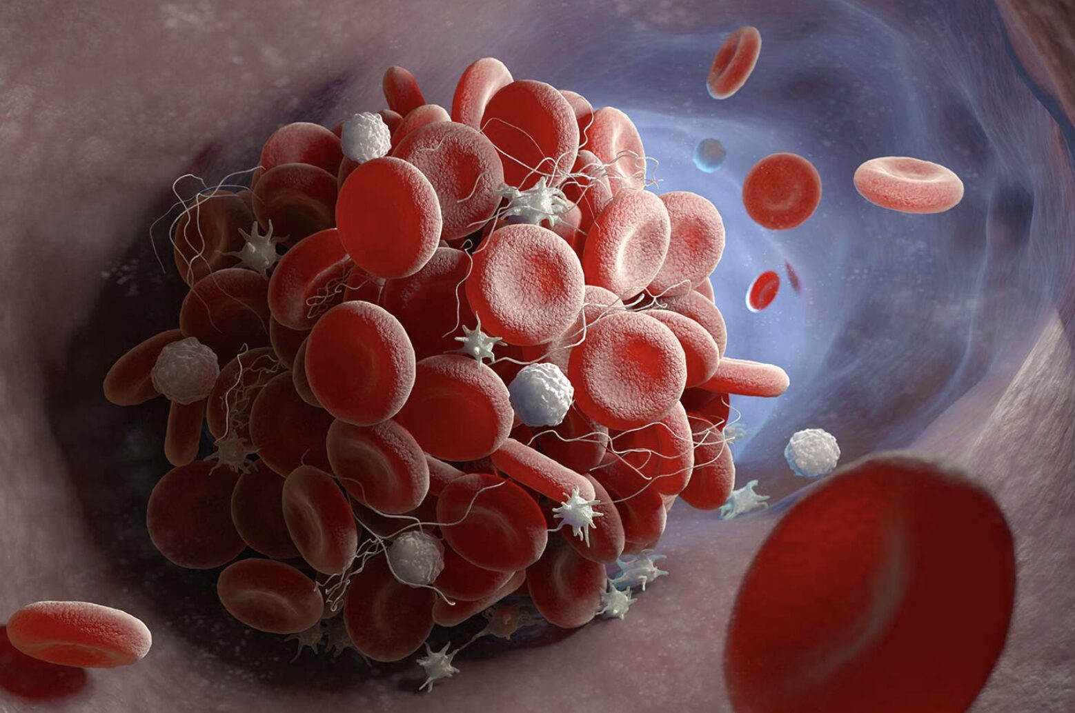 Giảm nguy cơ đau tim, đột quỵ và ngăn ngừa cục máu đông qua các bài tập đơn giản tại nhà