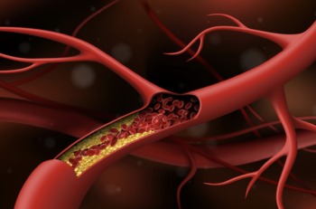 Xơ vữa mạch máu ở những vị trí nào là đáng lo ngại nhất?