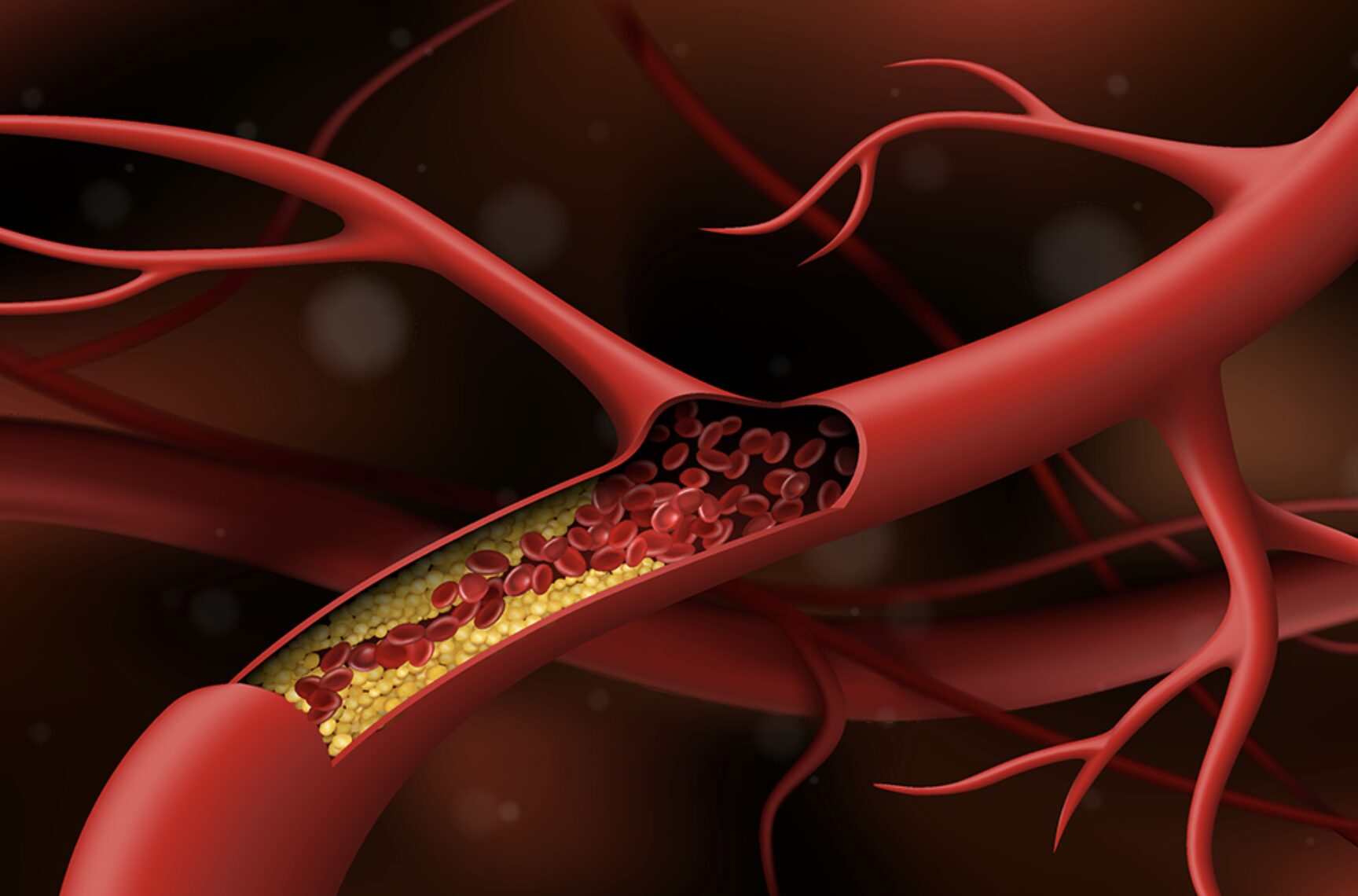 Xơ vữa mạch máu ở những vị trí nào là đáng lo ngại nhất?