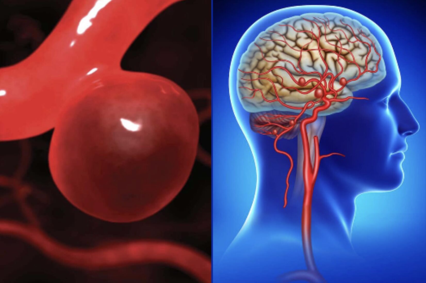 Phình mạch máu não nguy hiểm như thế nào?
