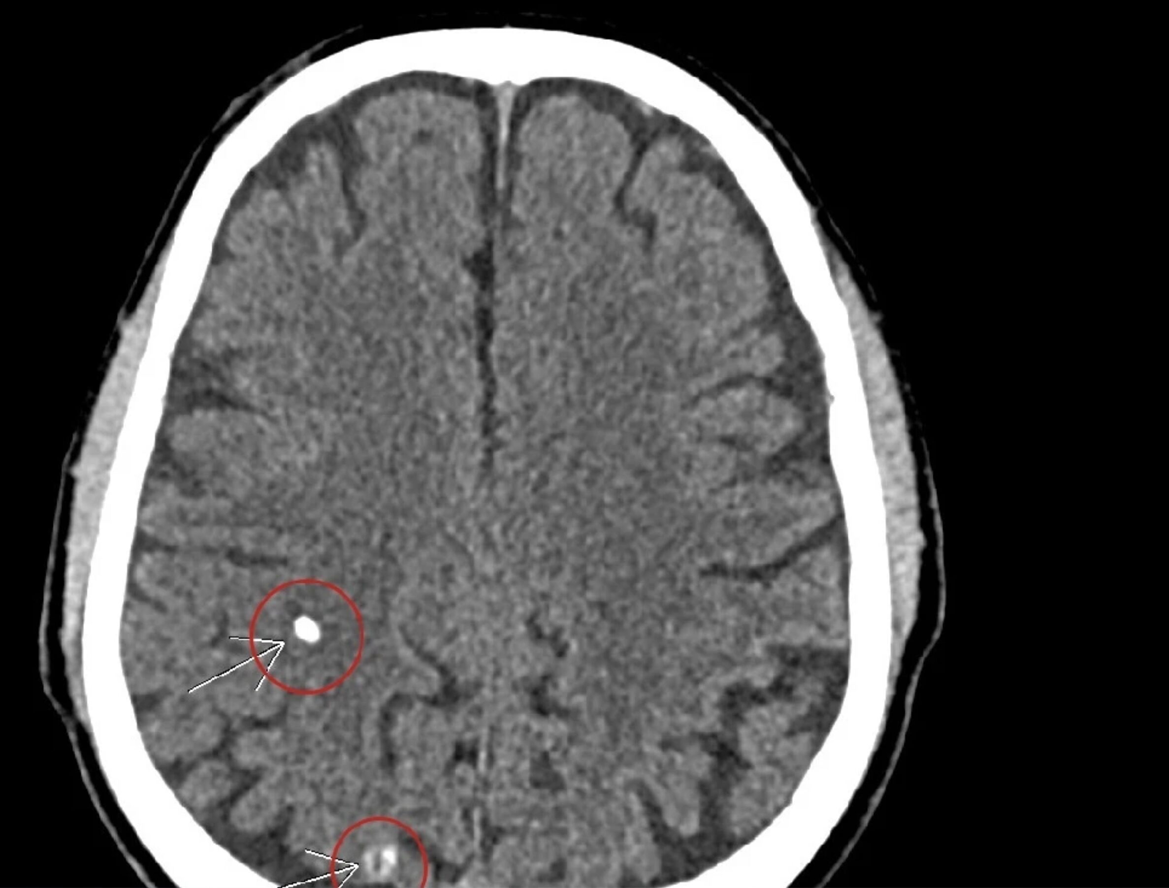 Chóng mặt kèm đau đầu, người đàn ông 66 tuổi bất ngờ phát hiện ấu trùng sán nằm rải rác trong não