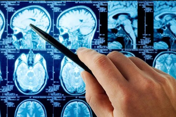 Trung tâm kiểm soát và phòng ngừa dịch bệnh Mỹ báo động về tỷ lệ tử vong do đột quỵ ở tuổi trung niên