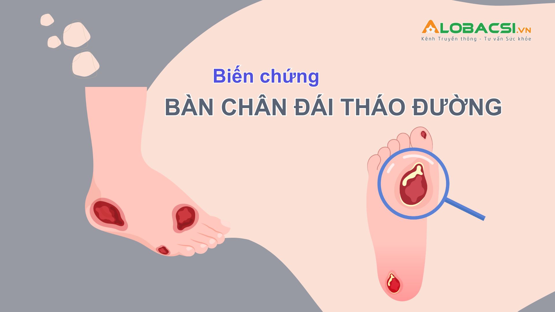 Biến chứng bàn chân đái tháo đường: Đừng chờ đến khi bị cắt cụt chi