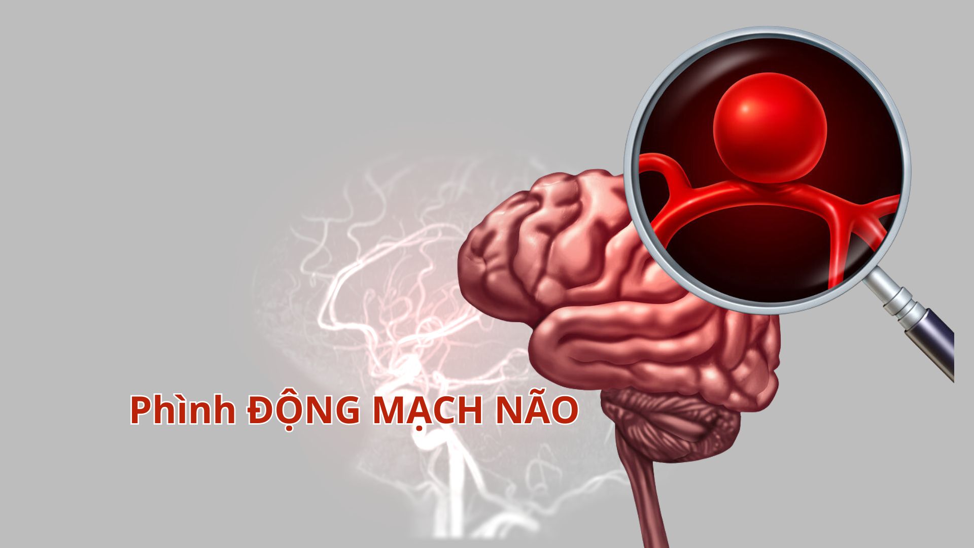 Phình động mạch não: Nhận biết và điều trị thế nào?