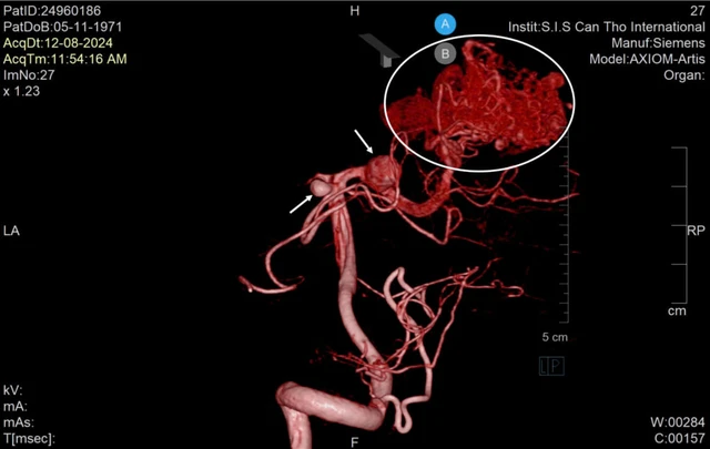 Cần Thơ: Du khách người Thanh Hóa thoát đột quỵ nhờ phát hiện sớm dấu hiệu