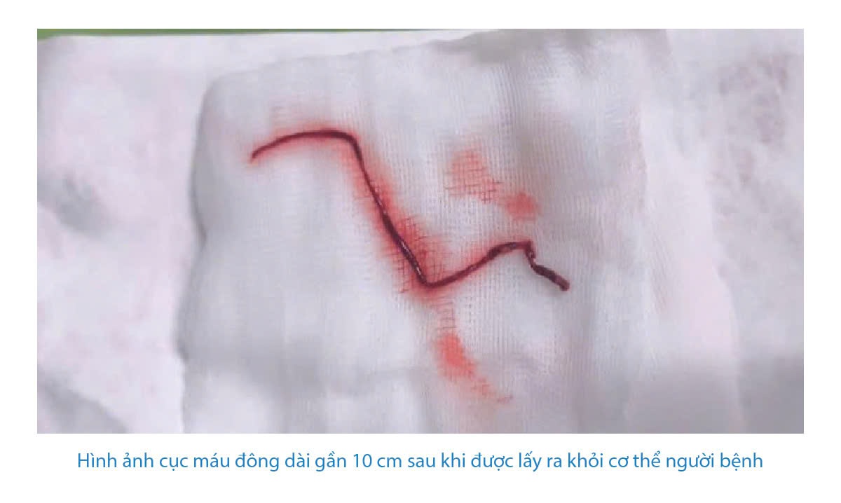 Phú Thọ: Cục máu đông dài gần 10cm đươc lấy ra khỏi mạch máu não người đàn ông 60 tuổi