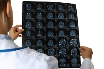 Chi phí gói tầm soát đột quỵ não tại Bệnh viện Trường Đại học Y Dược Cần Thơ là bao nhiêu?