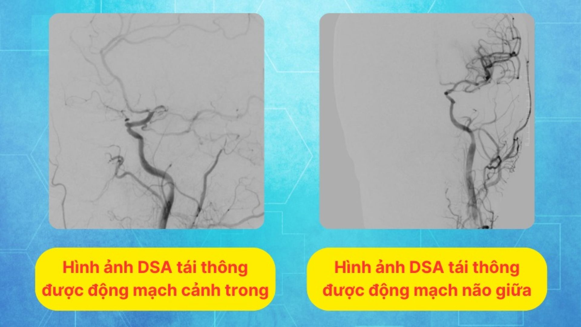 Cứu sống bệnh nhân đột quỵ não, nhập viện khi đã quá giờ vàng
