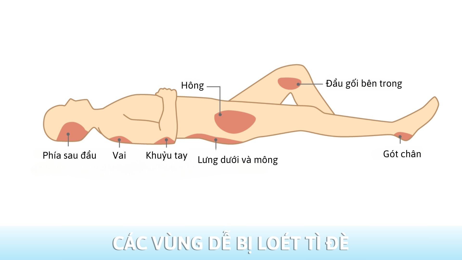 Bác sĩ hướng dẫn nhận biết và chăm sóc loét tì đè