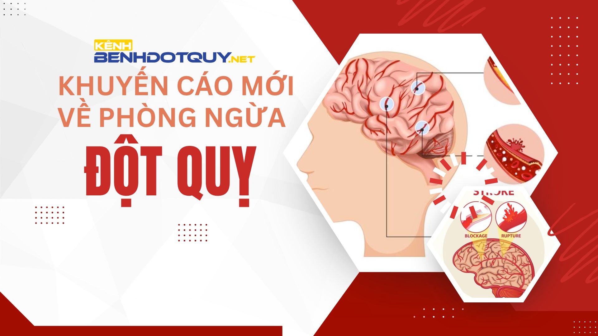 10 thông điệp quan trọng trong khuyến cáo mới về phòng ngừa đột quỵ