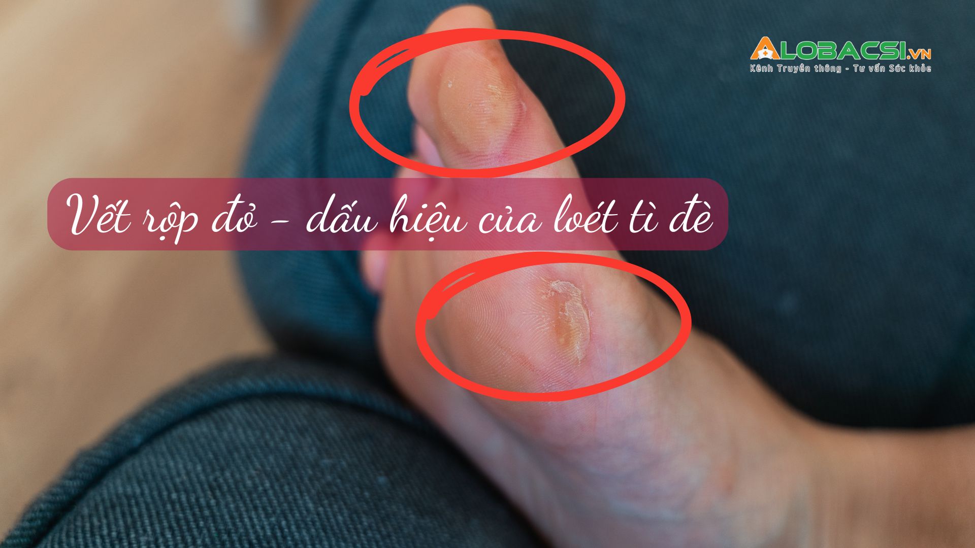 Loét tì đè làm tăng nguy cơ tử vong ở bệnh nhân sau đột quỵ