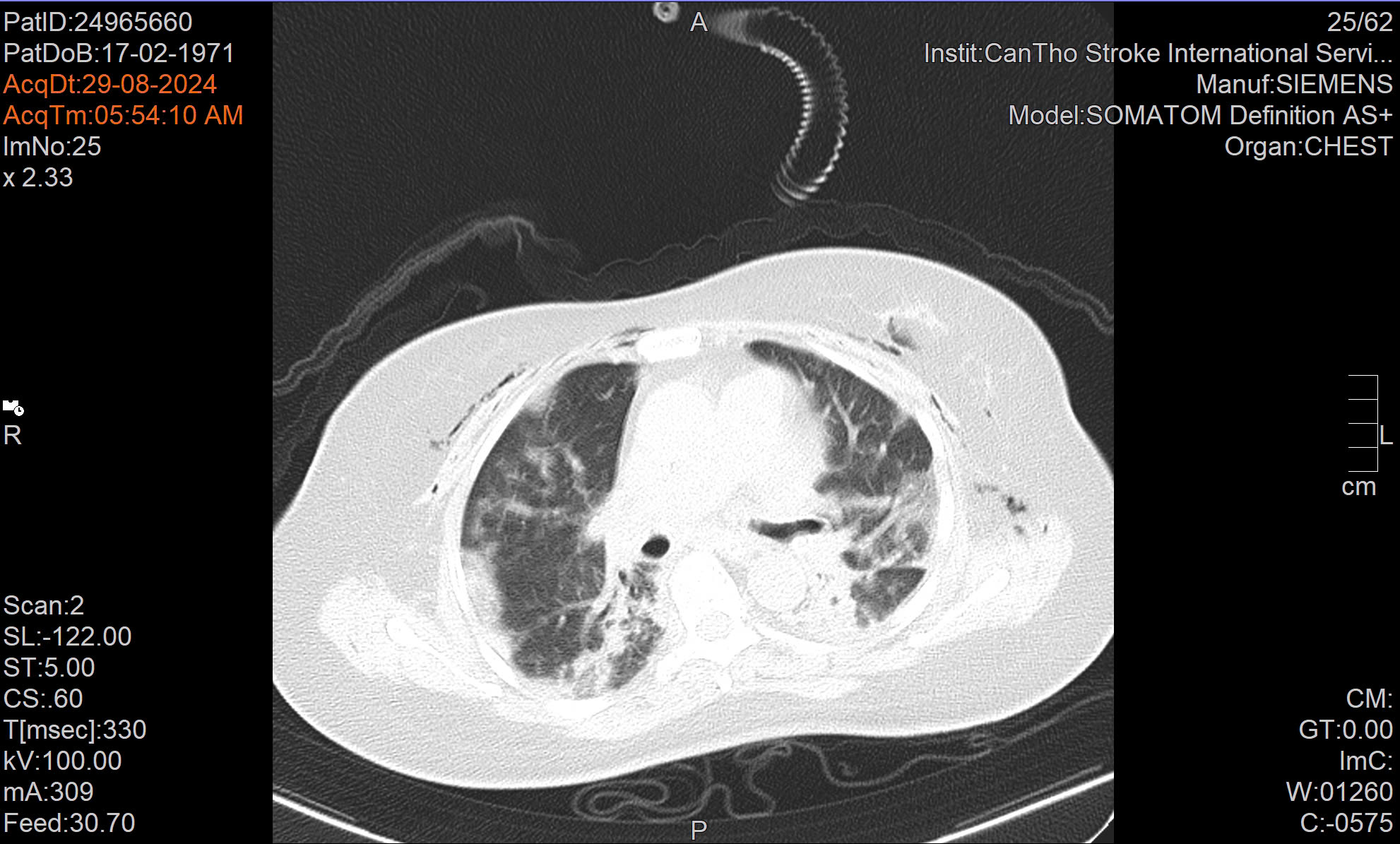 S.I.S Cần Thơ cứu sống nữ bệnh nhân 53 tuổi suy hô hấp cấp và viêm phổi nặng