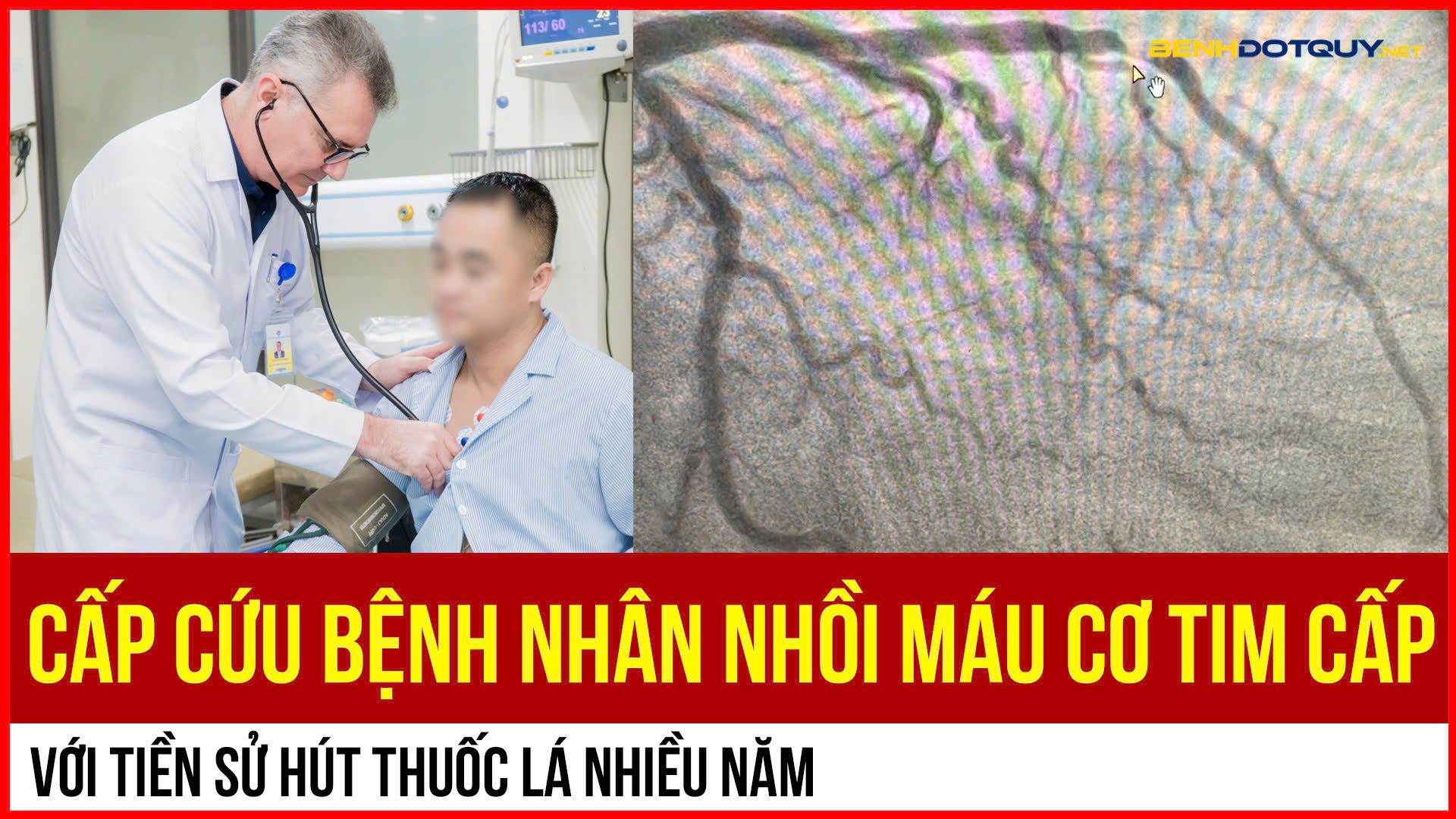 Người đàn ông có tiền sử hút thuốc lá nhập viện cấp cứu vì nhồi máu cơ tim