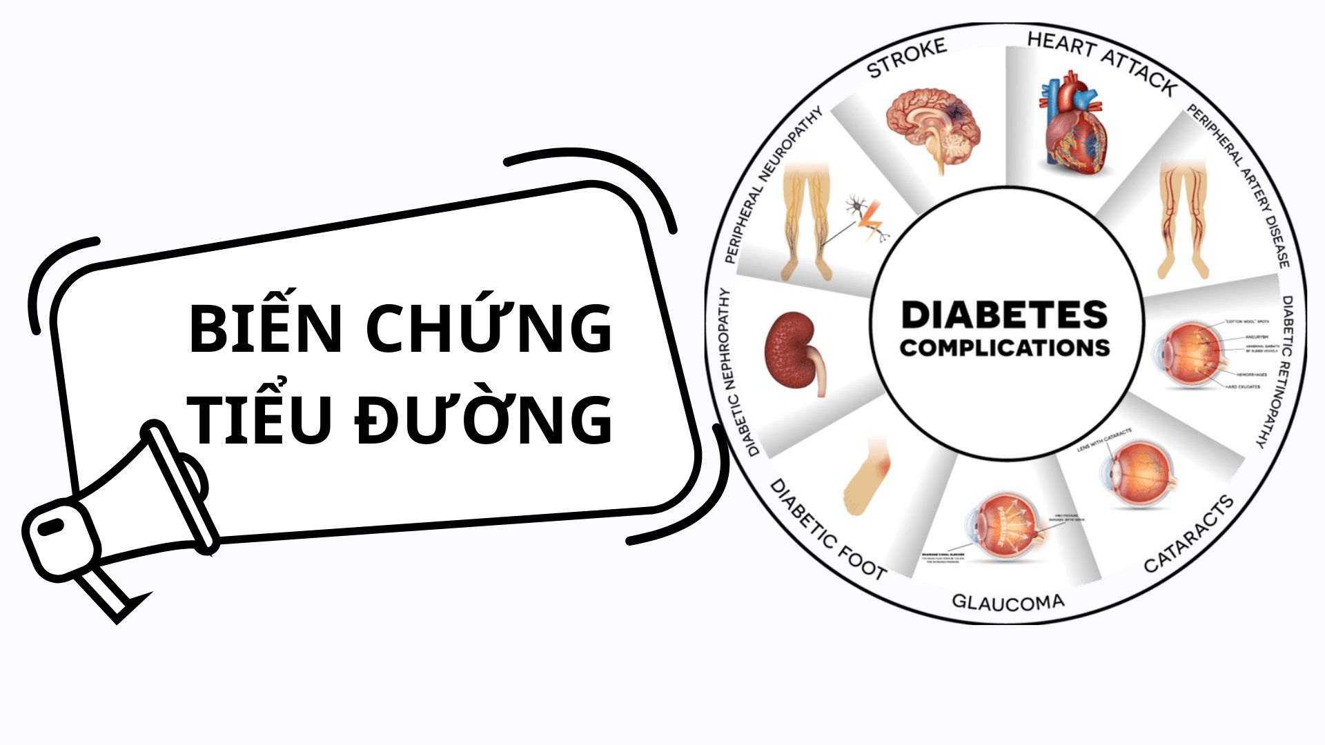 Nhận biết và phòng ngừa biến chứng bàn chân tiểu đường