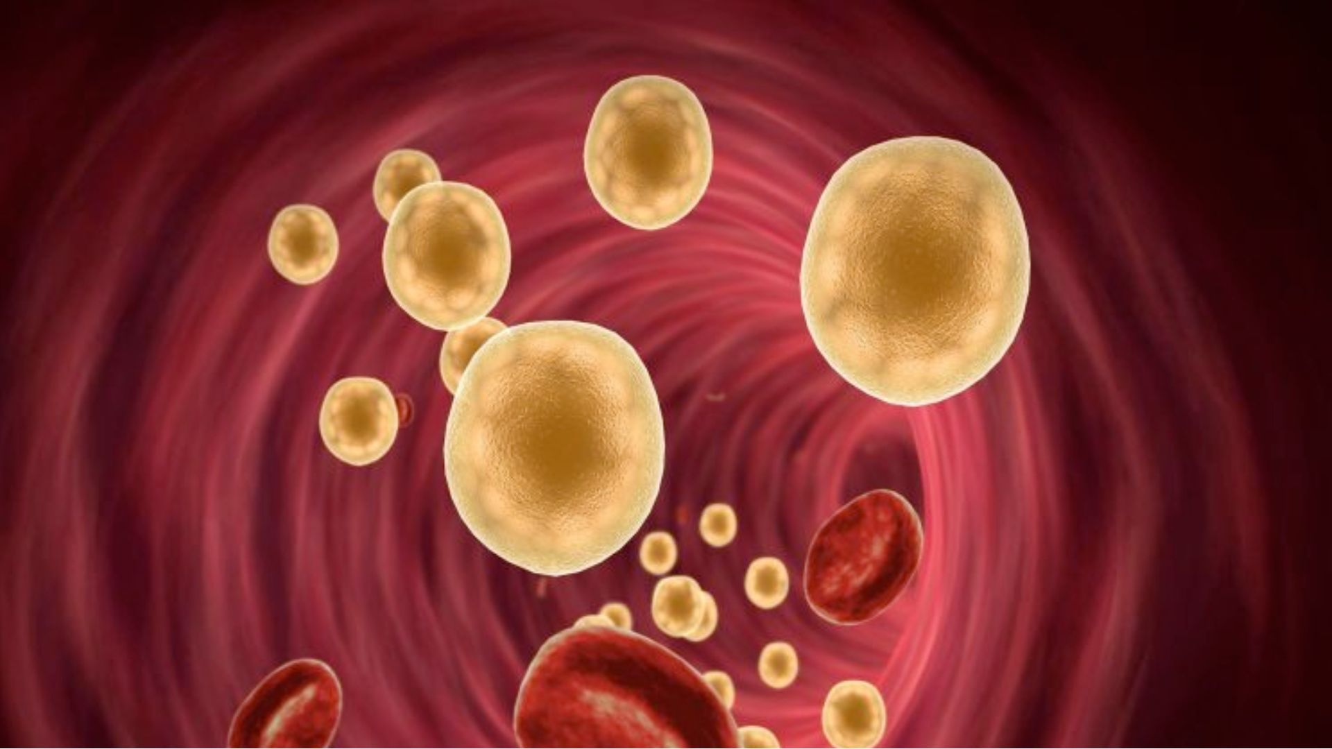 4 dấu hiệu cảnh báo mỡ máu cao