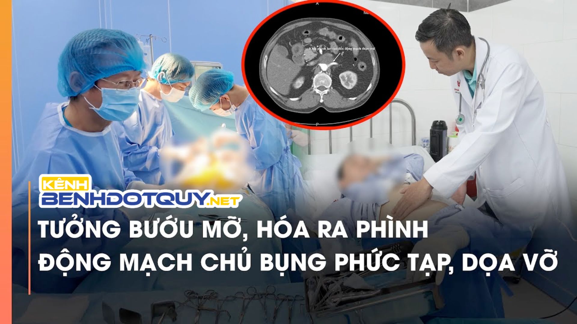 Tưởng bướu mỡ, hóa ra phình động mạch chủ bụng phức tạp, dọa vỡ