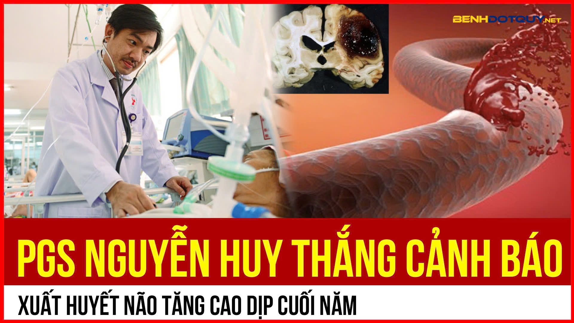 Xuất huyết não tăng cao dịp cuối năm