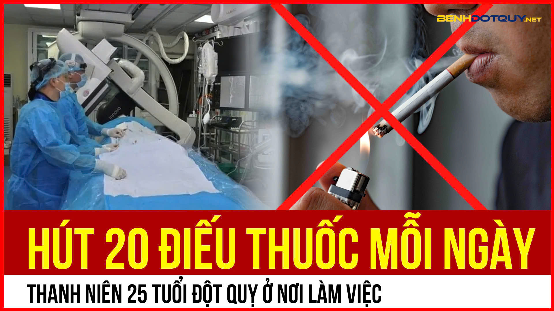 Hút 20 điếu thuốc mỗi ngày, thanh niên 25 tuổi đột quỵ