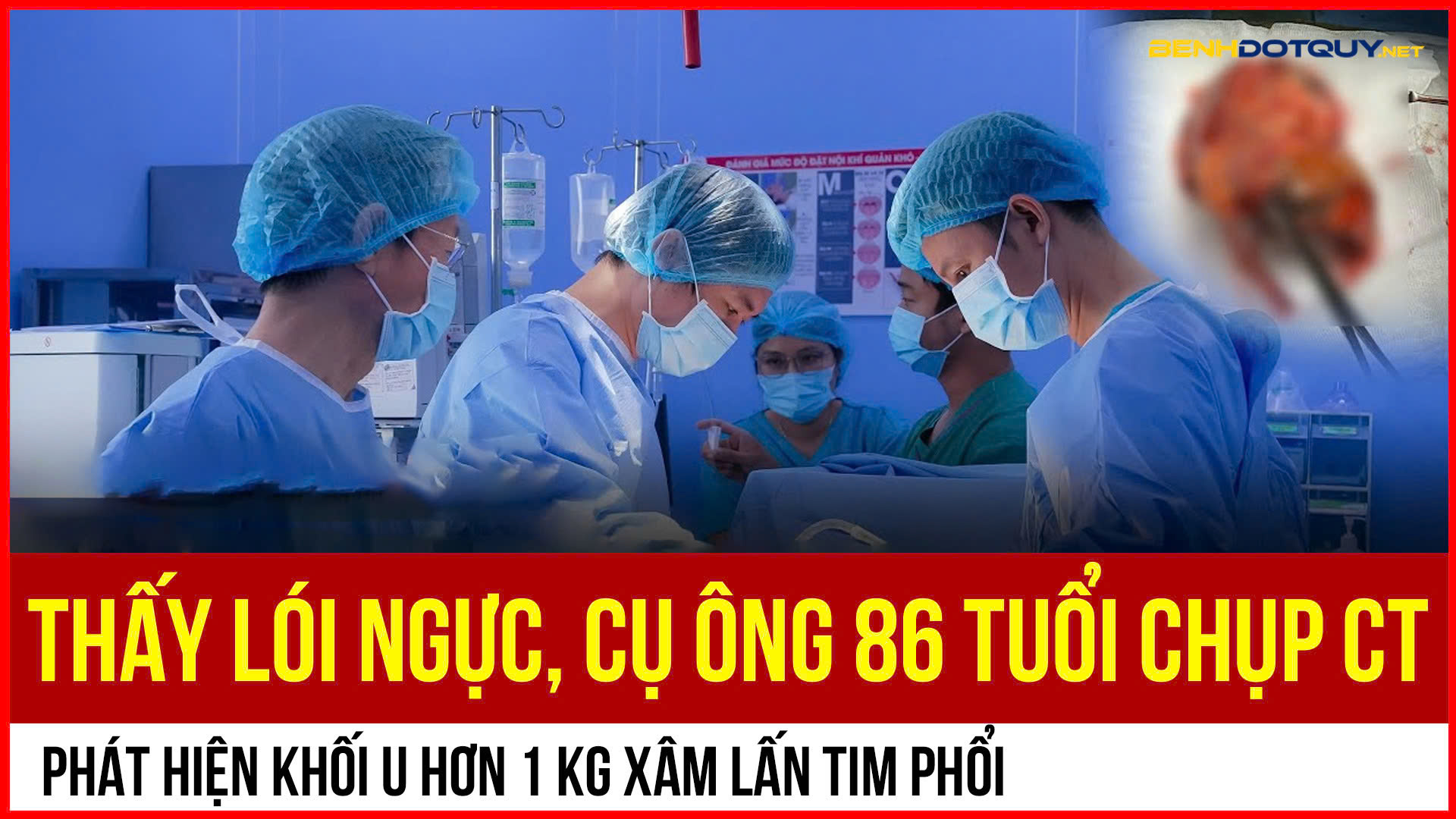 Khối u hơn 1kg xâm lấn tim phổi cụ ông 86 tuổi