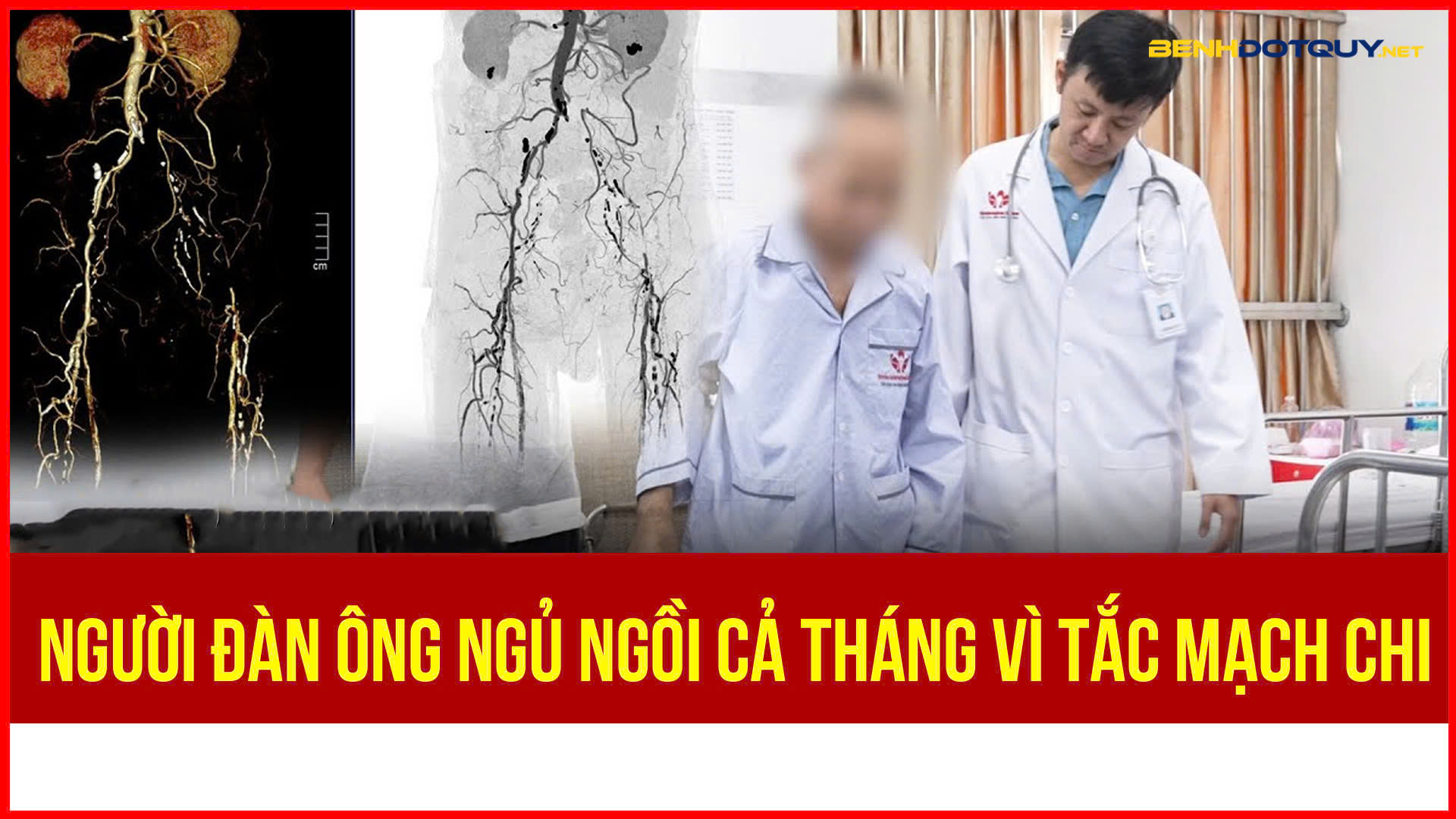 Ngủ ngồi cả tháng do tắc mạch chi