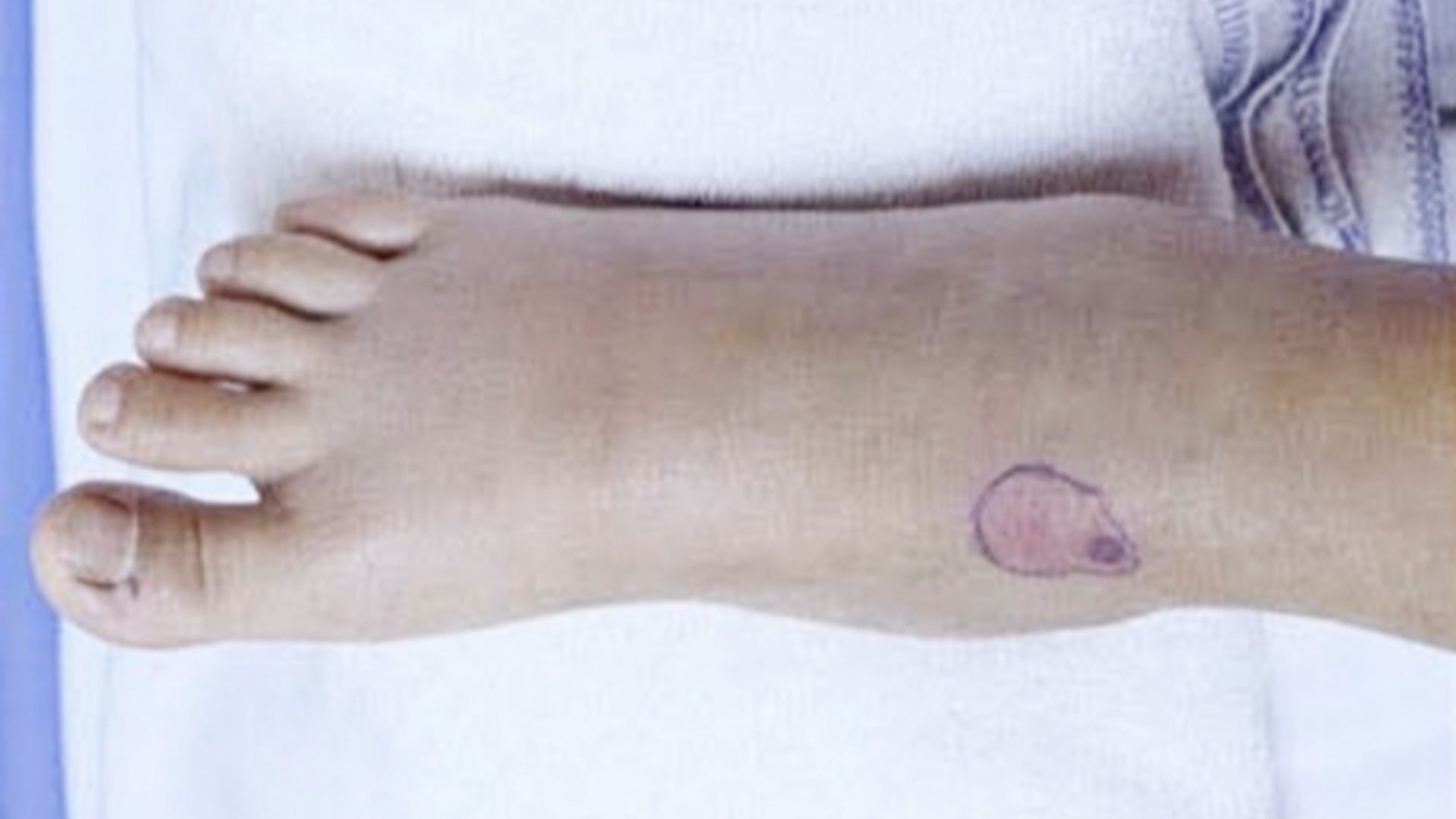 Rối loạn đông máu suýt mất mạng do chữa rắn cắn theo thầy lang