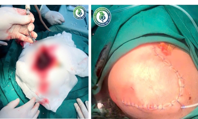 Bé trai 6 tháng tuổi ở Hải Phòng xuất huyết não, hôn mê vì đột quỵ