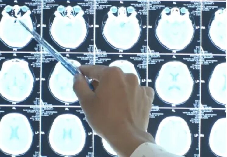 Đau đầu nặng, nhìn mờ, sụp mí mắt vì đột quỵ tuyến yên hiếm gặp