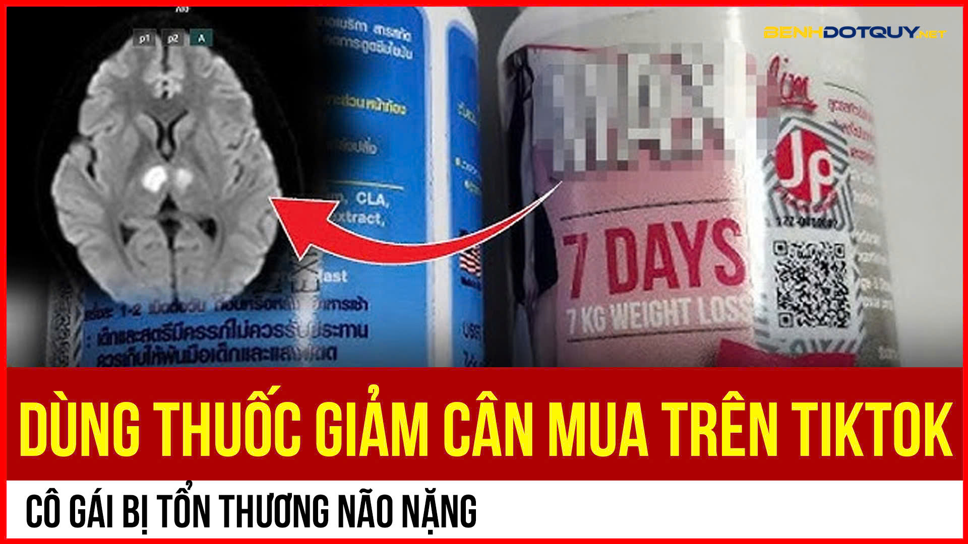 Tổn thương não nặng do dùng thuốc giảm cân mua trên TikTok