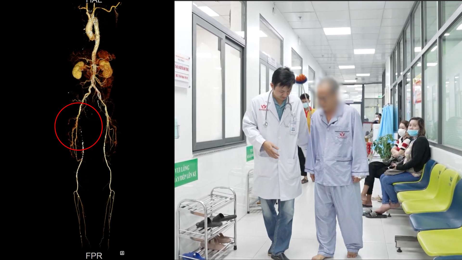 Tắc hoàn toàn 20 cm động mạch đùi nông do chủ quan với triệu chứng đau, mỏi chân