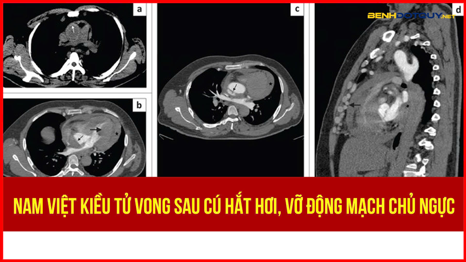 Nam Việt kiều tử vong sau cú hắt hơi, vỡ động mạch chủ ngực