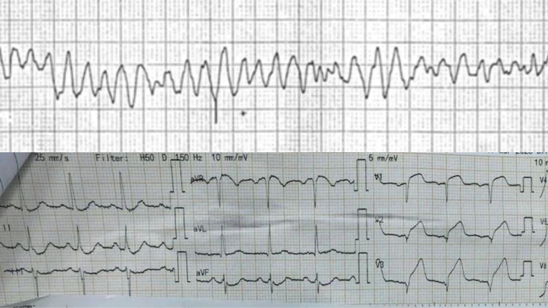 BV Nhân dân 115 cấp cứu thành công ca rung thất do nhồi máu cơ tim cấp