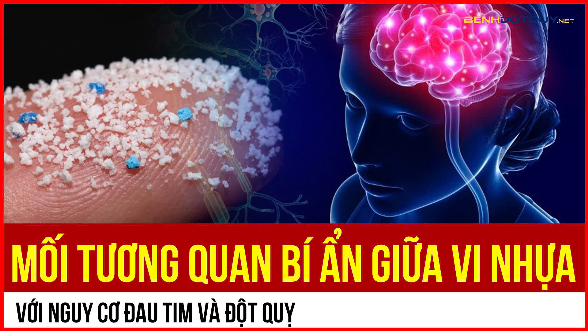 Vi nhựa và đột quỵ: Đâu là mối tương quan?