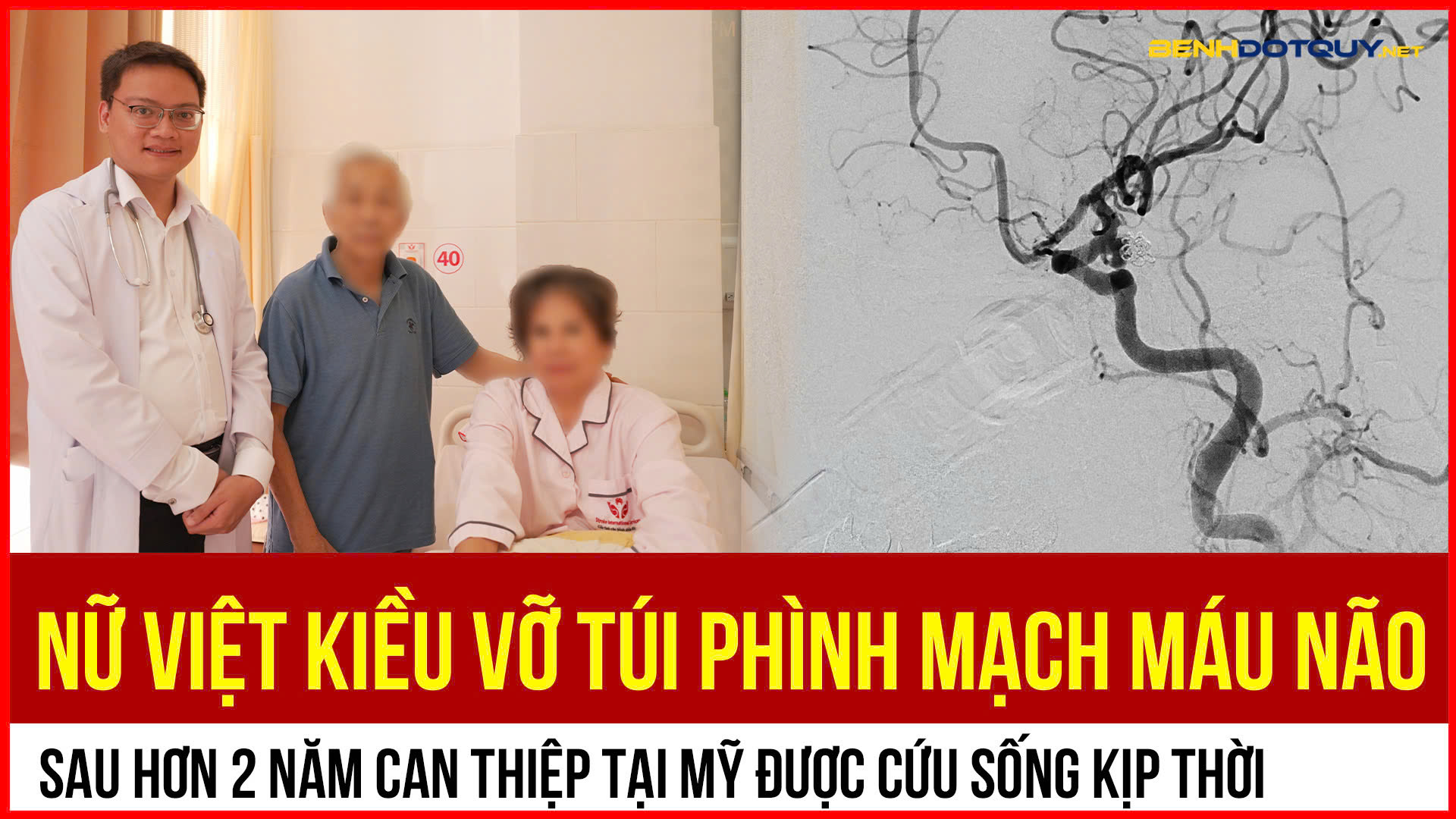 Điều trị thành công cho nữ Việt kiều vỡ túi phình lần 2 sau hơn 2 năm can thiệp