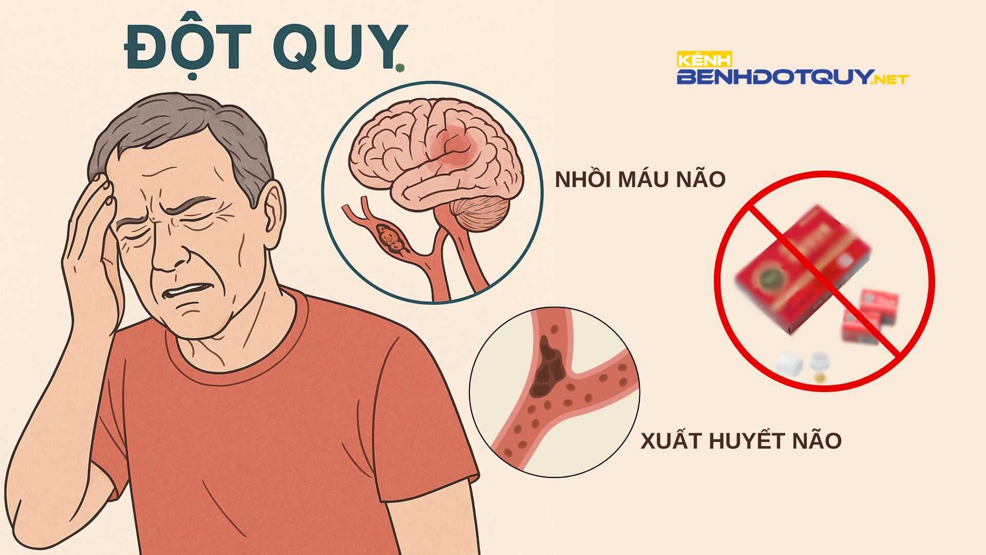 Uống an cung ngưu hoàng hoàn khi đột quỵ, người phụ nữ mất “thời gian vàng” điều trị