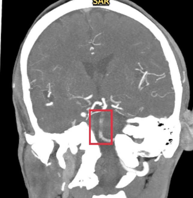 Người đàn ông đột quỵ khi đang bế cháu, được cứu sống trong thời gian vàng