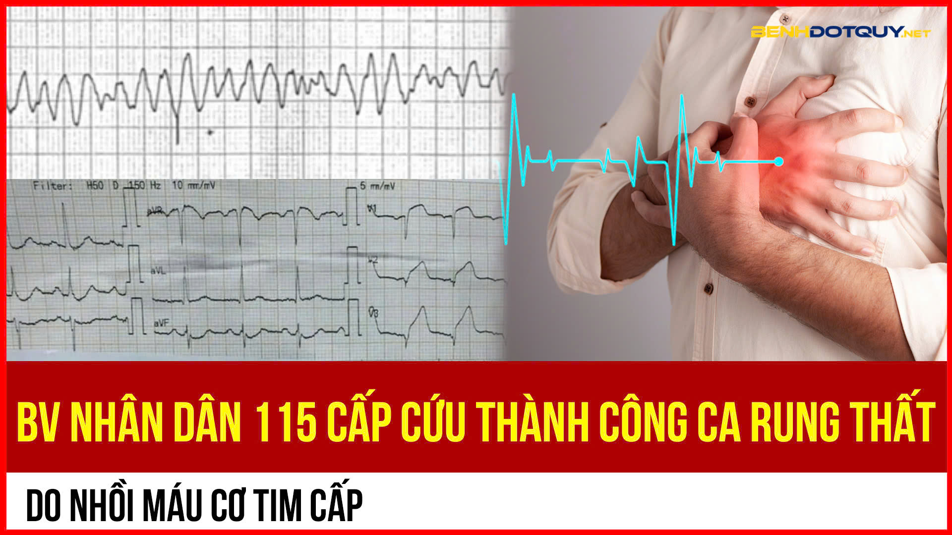Cấp cứu thành công trường hợp rung thất do nhồi máu cơ tim