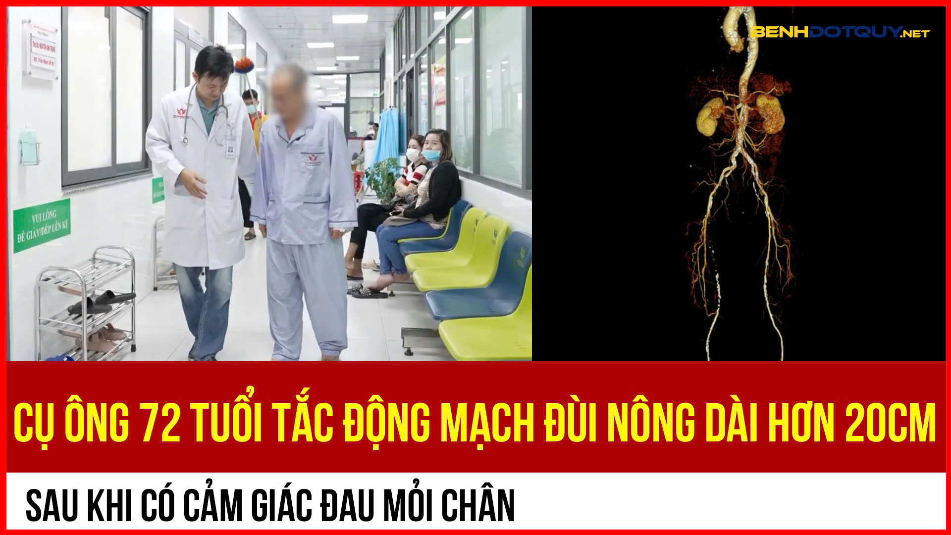 Tưởng đau mỏi do tuổi già, cụ ông 72 tuổi bị tắc động mạch đùi nông hơn 20cm