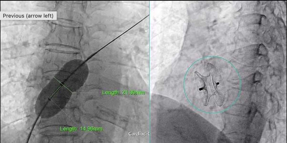 Đà Nẵng: Kịp thời bít lỗ thông liên nhĩ cho bệnh nhân tim bẩm sinh