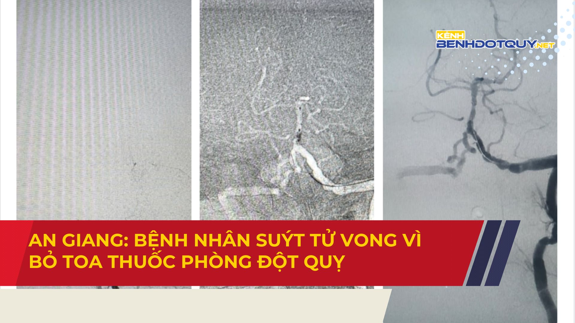 An Giang: Bệnh nhân suýt tử vong vì bỏ toa thuốc phòng đột quỵ
