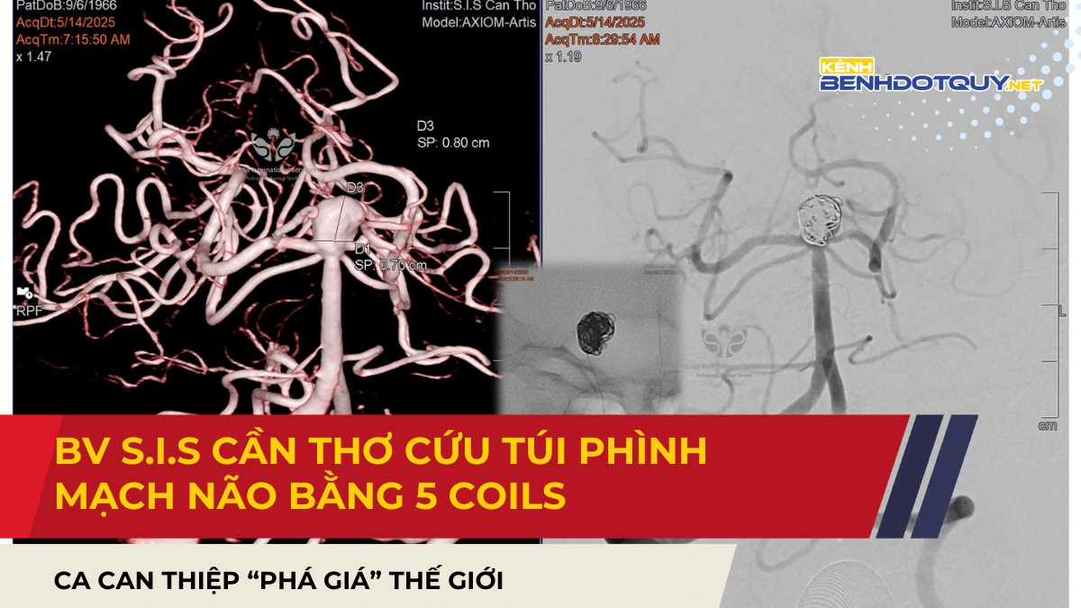 Cứu túi phình mạch não bằng 5 coils: Ca can thiệp “phá giá” thế giới tại Bệnh viện S.I.S Cần Thơ