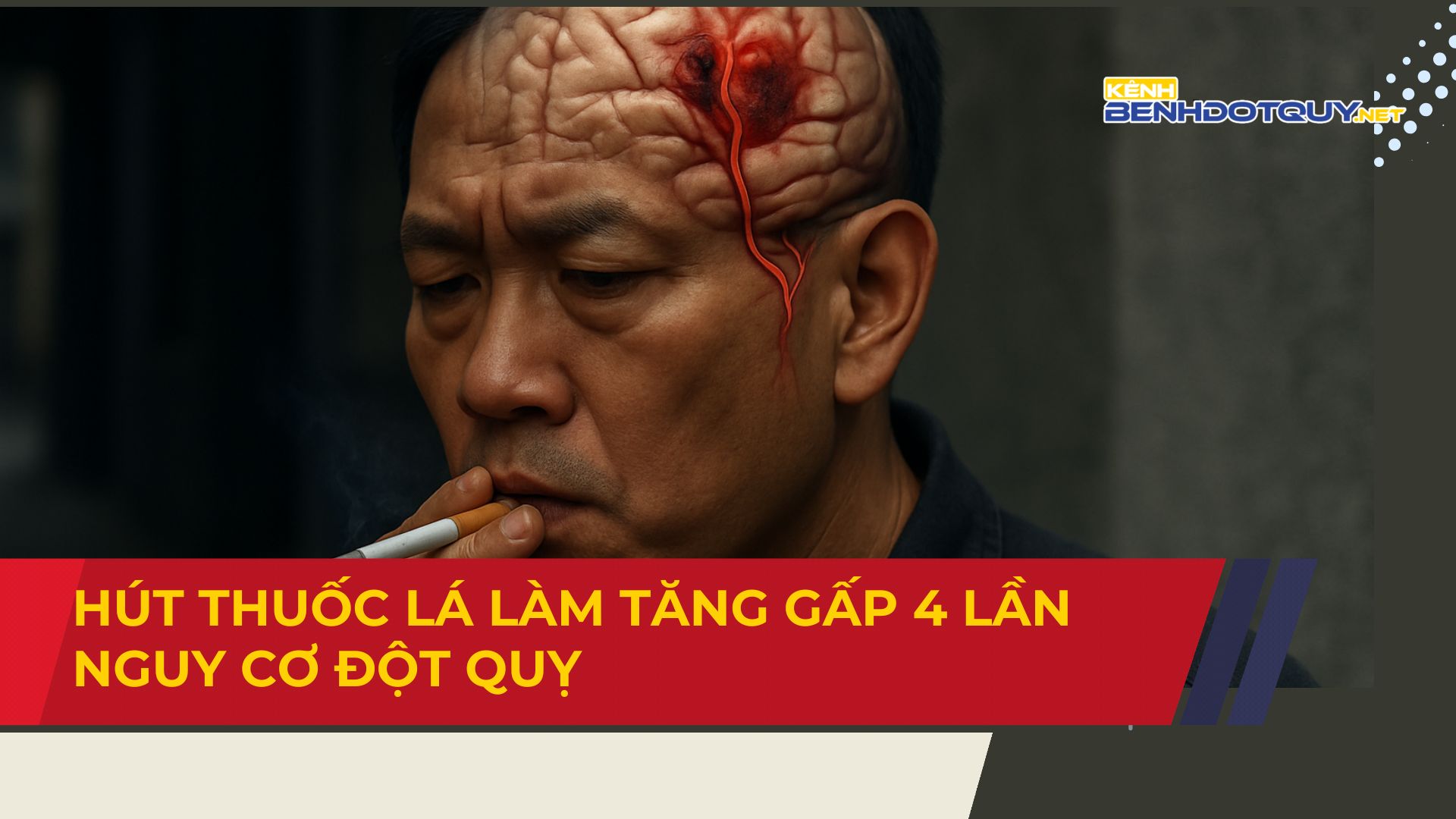 Hút thuốc lá làm tăng gấp 4 lần nguy cơ đột quỵ