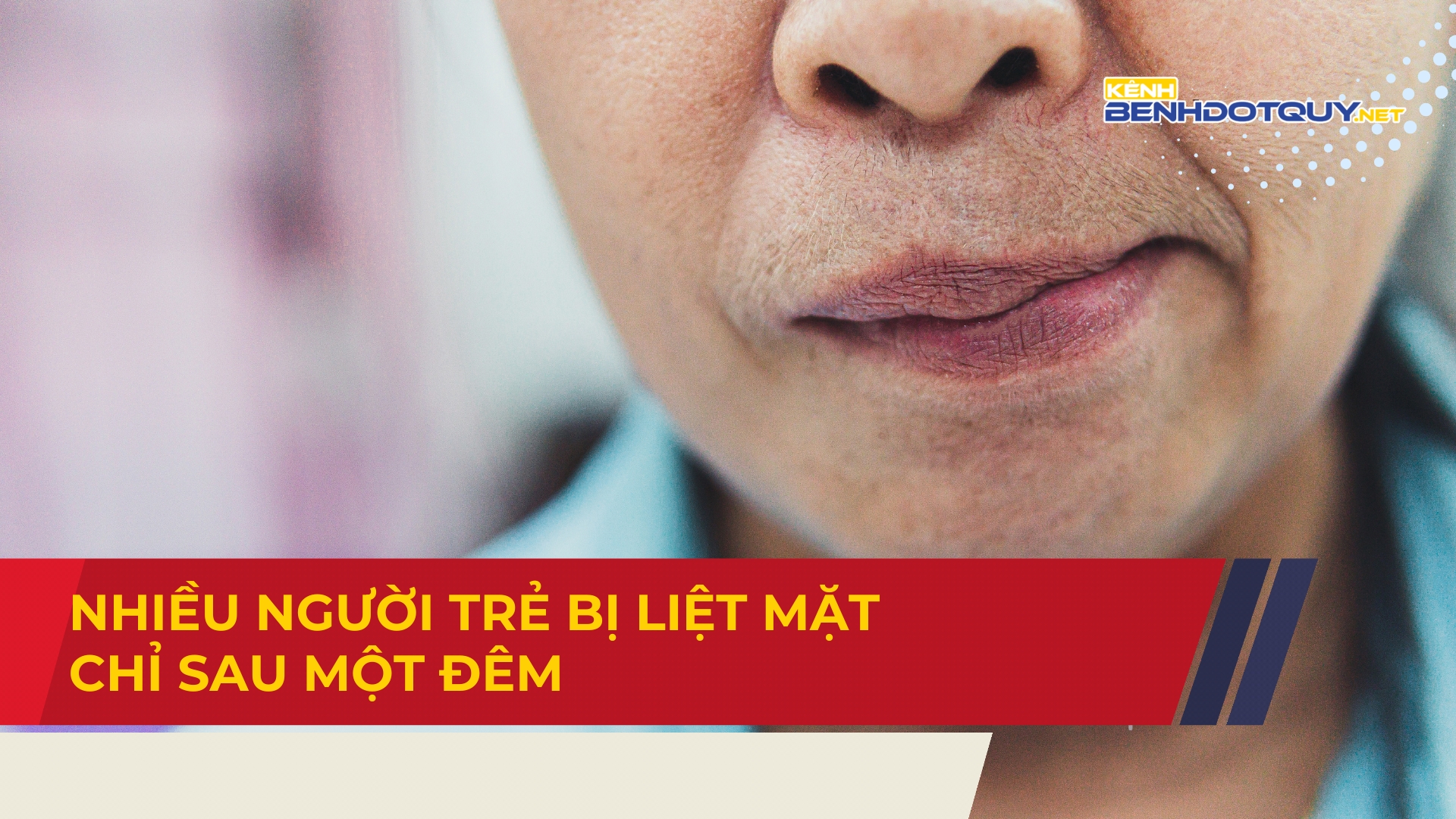 Gió lạnh, nhiều người trẻ bị liệt mặt chỉ sau một đêm