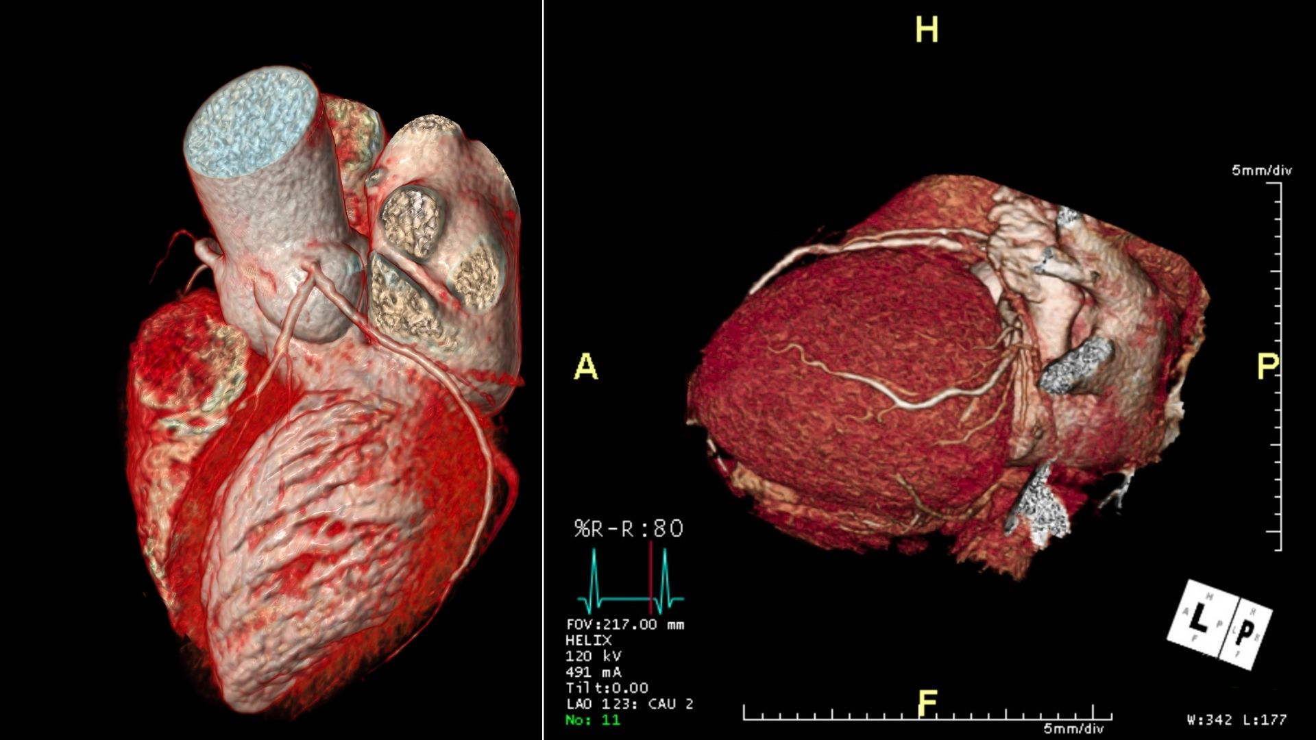 Chụp CT động mạch vành có tiêm thuốc cản quang tại BV Nguyễn Tri Phương giá bao nhiêu?