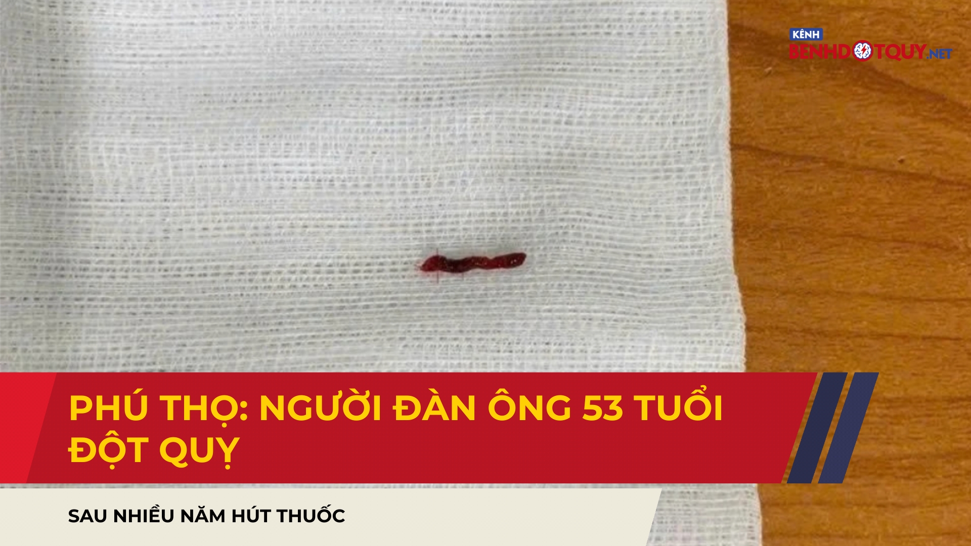 Phú Thọ: Người đàn ông 53 tuổi đột quỵ sau nhiều năm hút thuốc