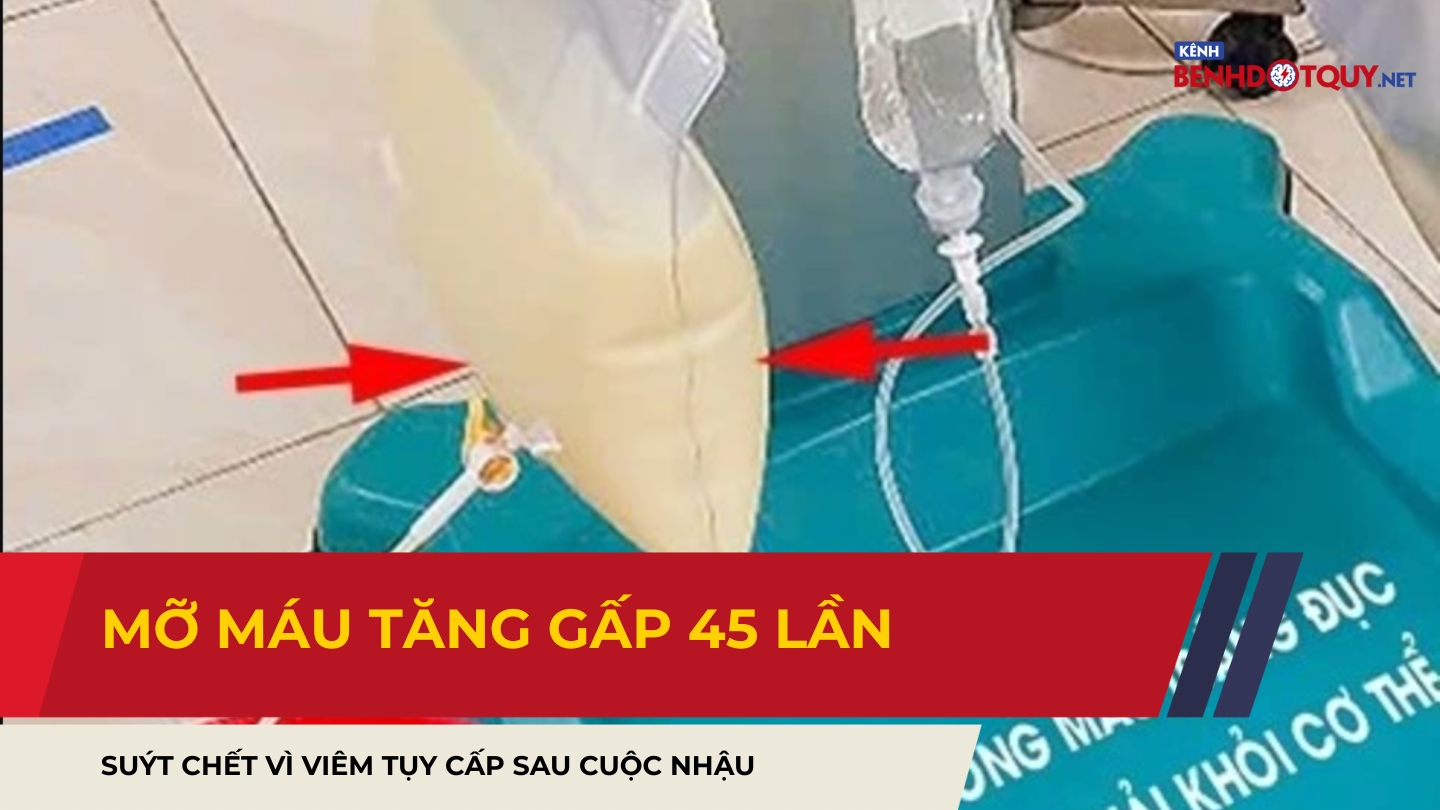 Mỡ máu tăng gấp 45 lần: Bệnh nhân suýt chết vì viêm tụy cấp sau cuộc nhậu