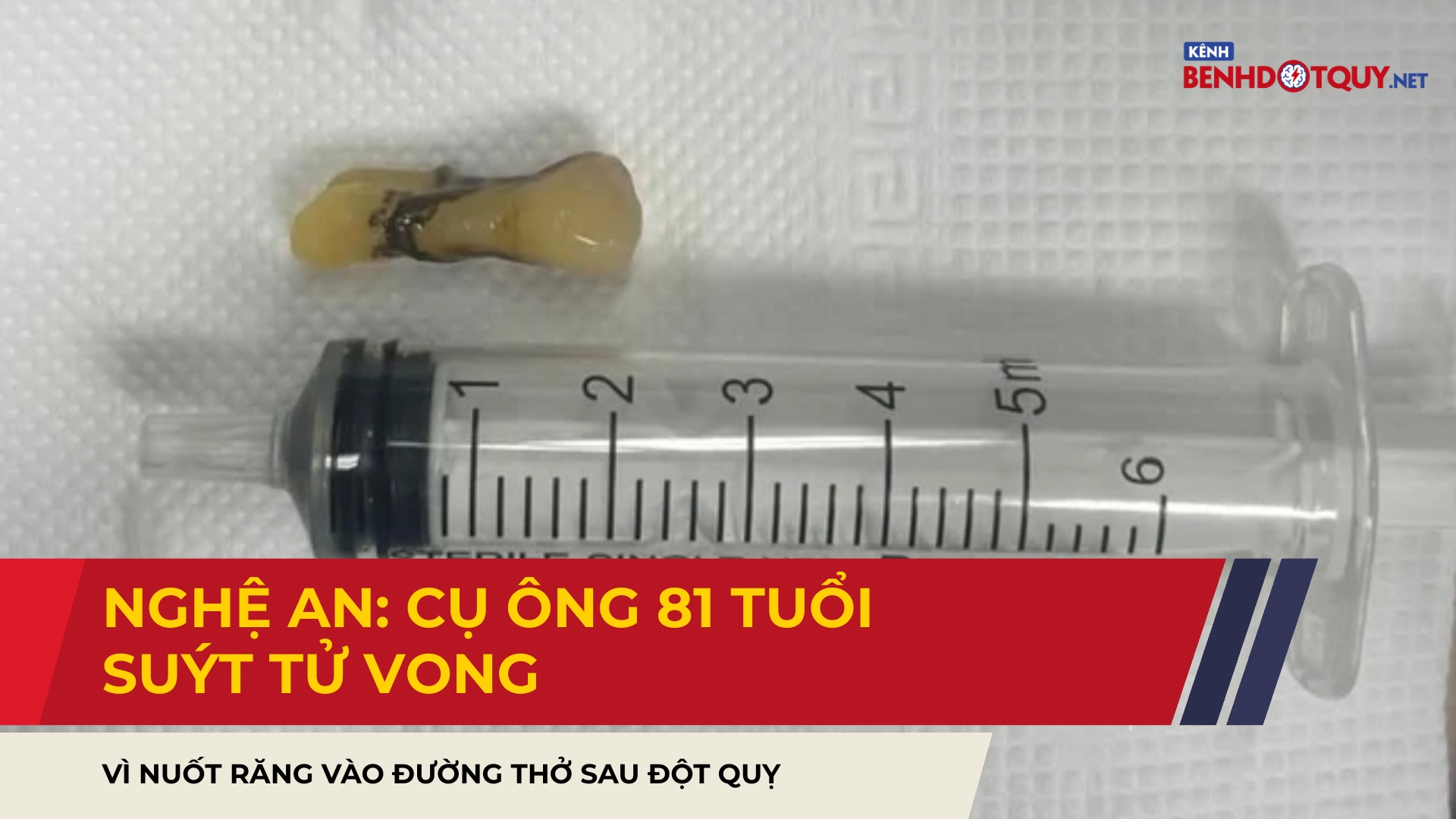 Nghệ An: Cụ ông 81 tuổi suýt tử vong vì nuốt răng vào đường thở sau đột quỵ