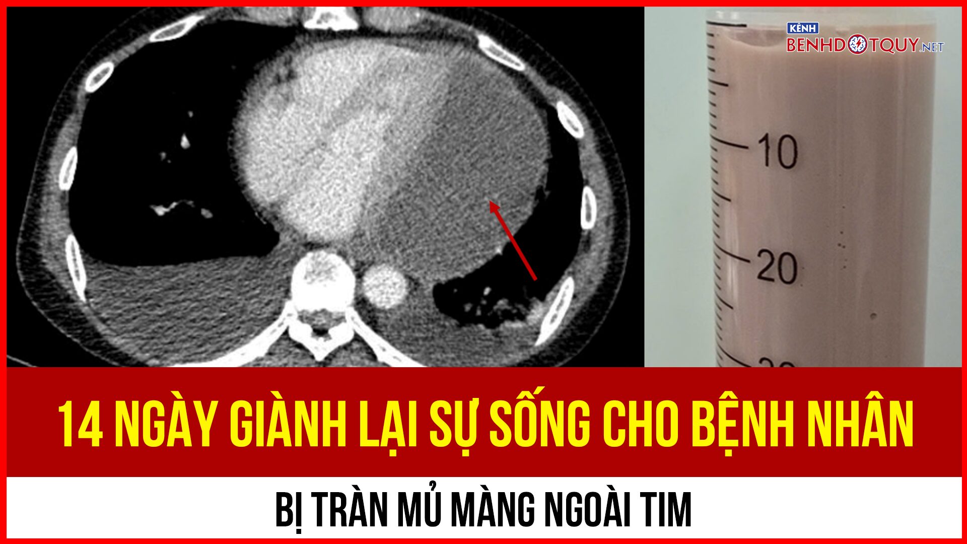 Cứu sống bệnh nhân tràn mủ ngoài tim