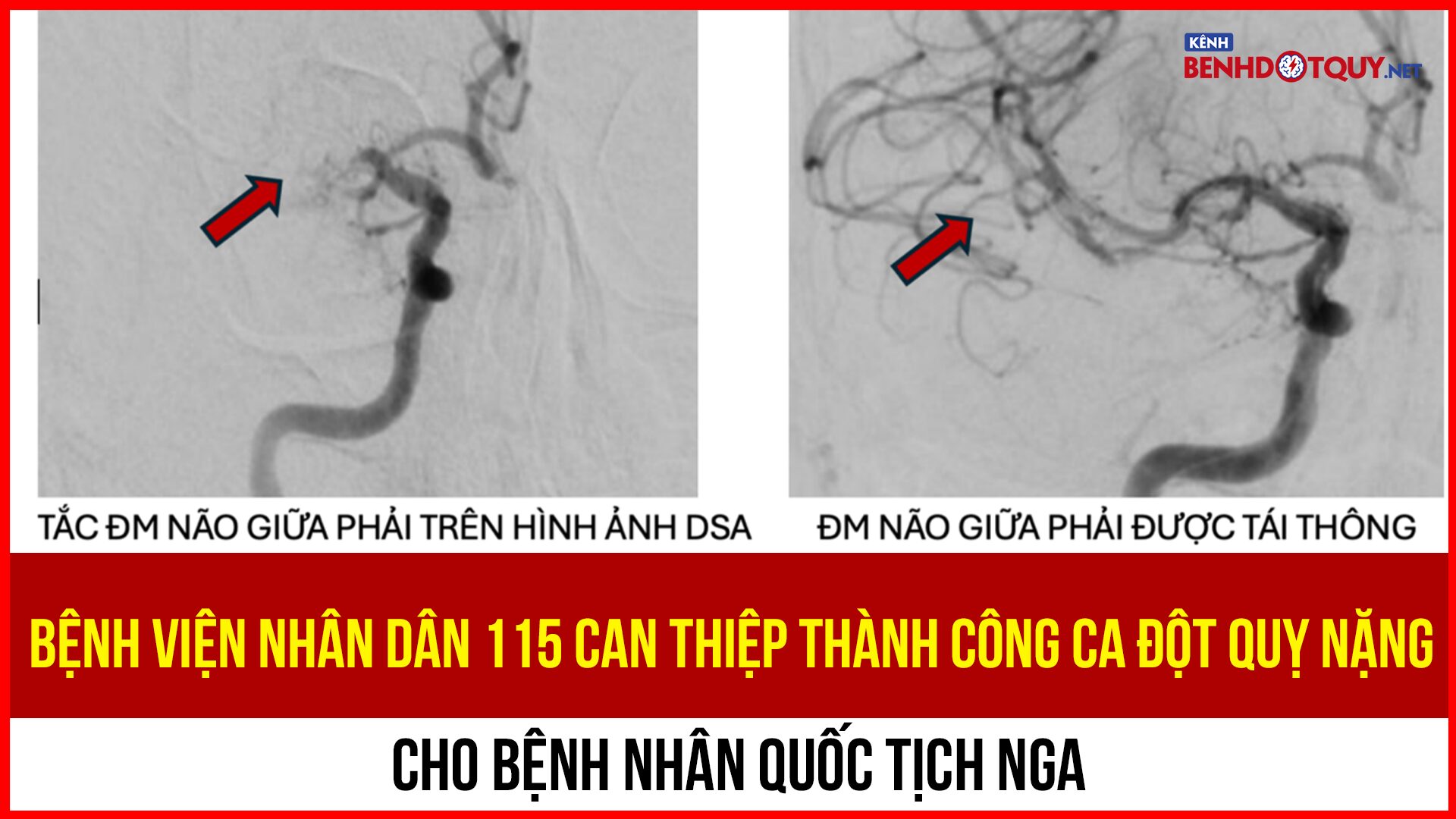 Bệnh viện Nhân dân 115 can thiệp thành công ca đột quỵ nặng cho bệnh nhân quốc tịch Nga