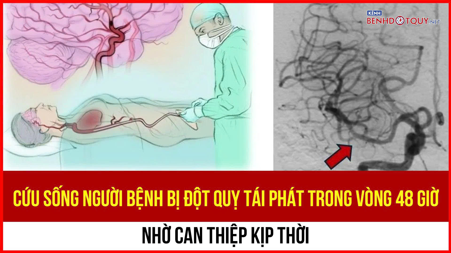 Cứu sống người bệnh bị đột quỵ tái phát trong vòng 48 giờ nhờ can thiệp kịp thời