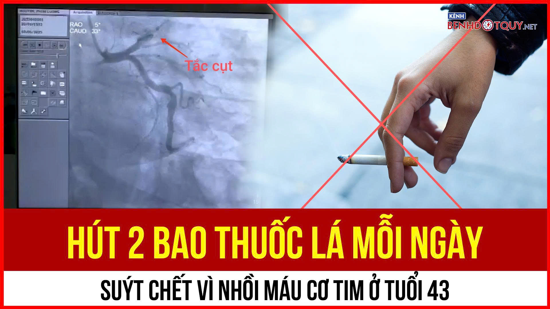 Hút 2 bao thuốc lá mỗi ngày, suýt chết vì nhồi máu cơ tim ở tuổi 43